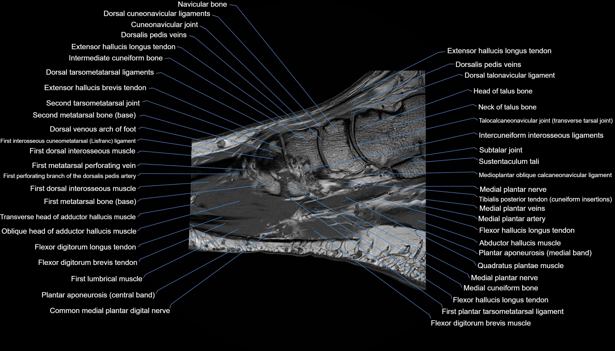 MRI mid foot sagittal cross sectional anatomy 3T  radiology  image-img-00001-00027.webp